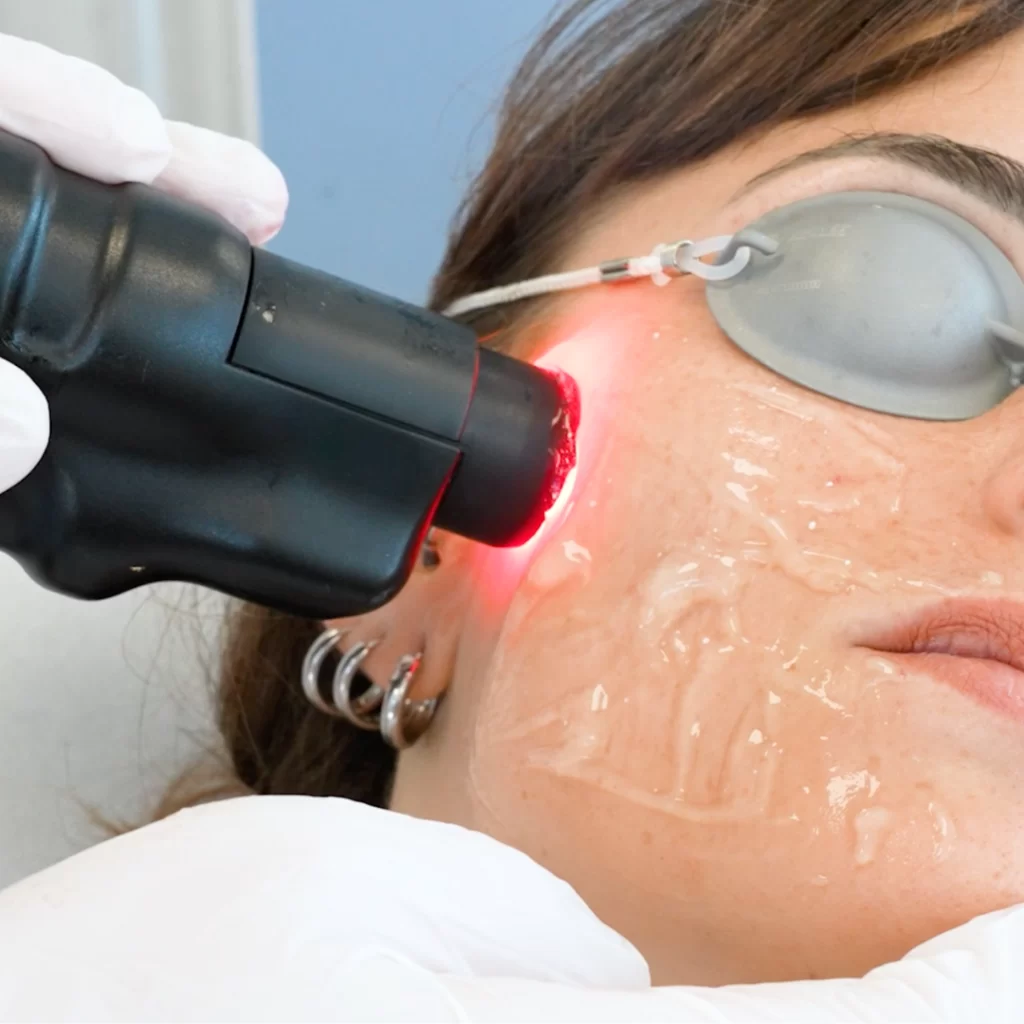 laserowe odmładzanie skóry laser wolumetryczny